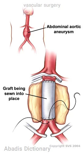 vascular surgery